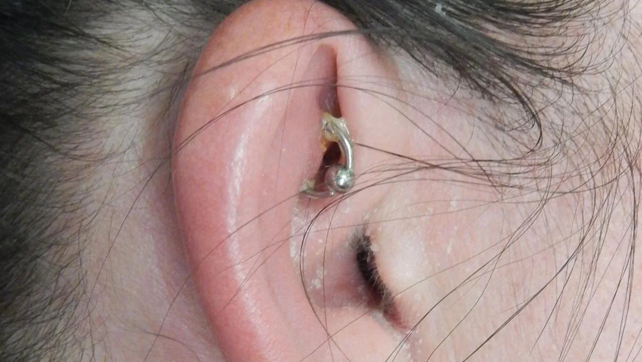 Common Causes of Crusting Around Piercings