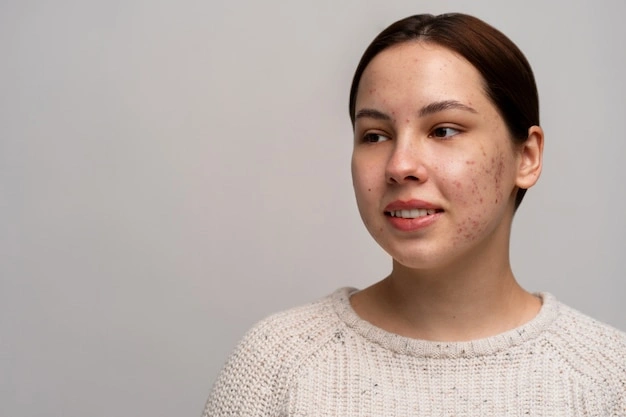 Discover Natural Solutions for Rosacea Skin Care