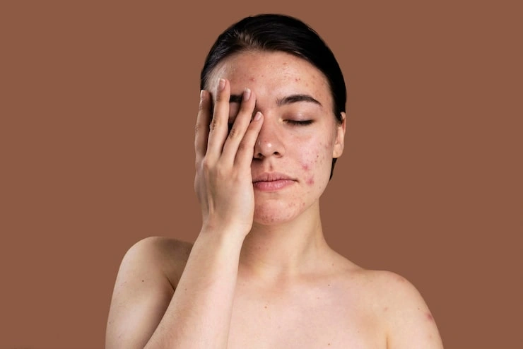 What Makes Hormonal Acne Different